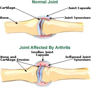 Arthritis Picture