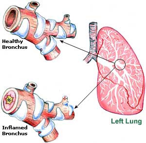 Bronchitis Picture