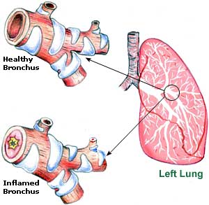 Home Remedies For Bronchitis In Pregnant Women