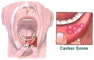 Canker Sores Picture