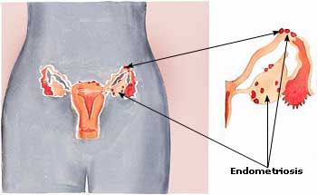 Endometriosis Picture