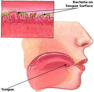 Halitosis Picture