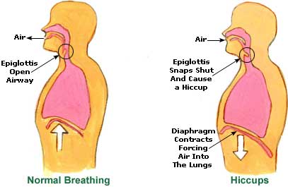 Hiccups Picture