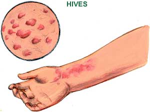 Hives Picture