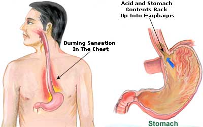 Hyperacidity and Heartburn Picture