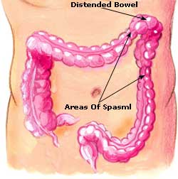 Irritable Bowel Syndrome Picture