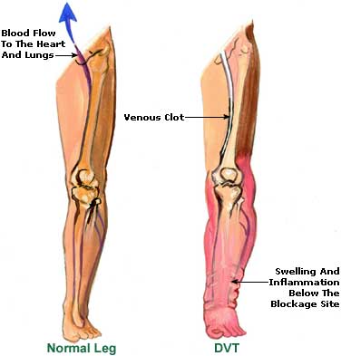 Cause Of Leg And Foot Cramps 16