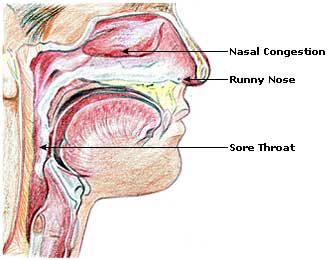 Baby With Cough And Green Mucus