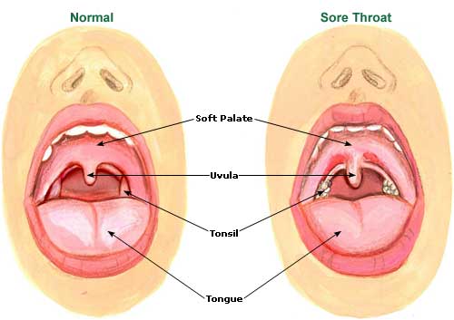 Sore Throat Picture