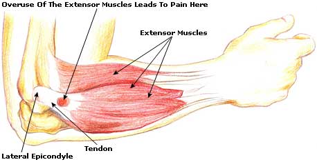 Tennis Elbow Causes