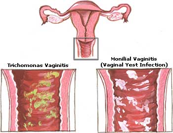 Yeast infections during pregnancy |.