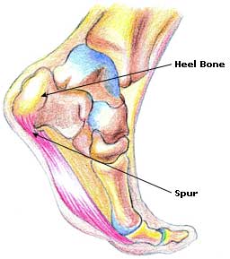 Heel Bone Spur Pain