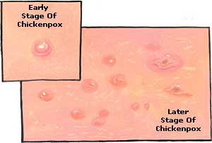 Chicken Pox Picture