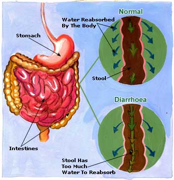 Diarrhoea Picture