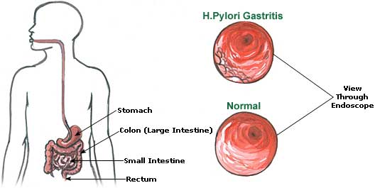 Gastritis Picture