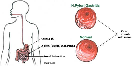 Antral Gastritis Diet Chart