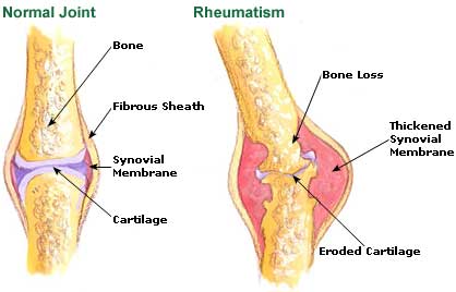 Rheumatism  Picture