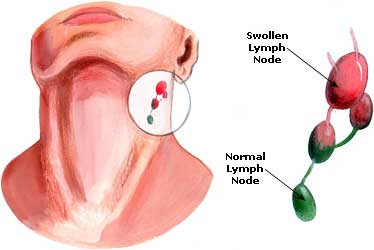 Sore Throat Picture