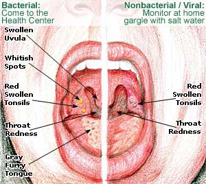 Tonsillitis Picture